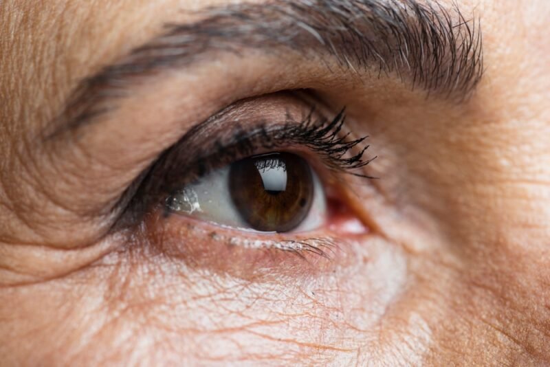 blefaroplastia a laser blefaroplastia a laser