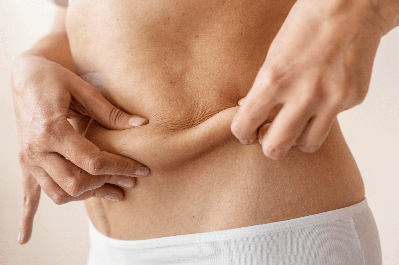 flacidez abdominal flacidez abdominal