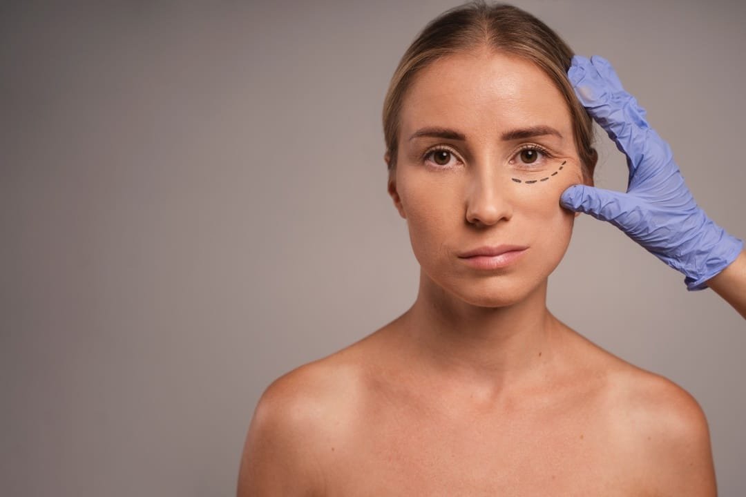 Blefaroplastia-Flacidez no Olhar Flacidez no Olhar