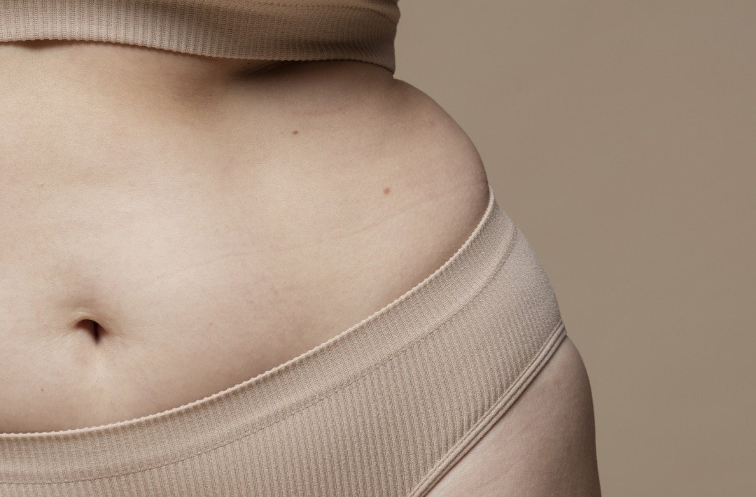 Lipedema 3 Melhores Tratamentos para o Seu Bem-estar Lipedema: 3 Melhores Tratamentos para o Seu Bem-estar