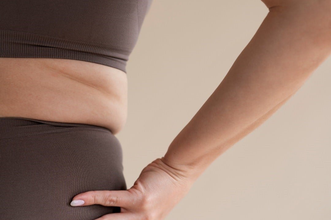 Qual a Melhor Solução para a Flacidez Corporal Qual a Melhor Solução para a Flacidez Corporal