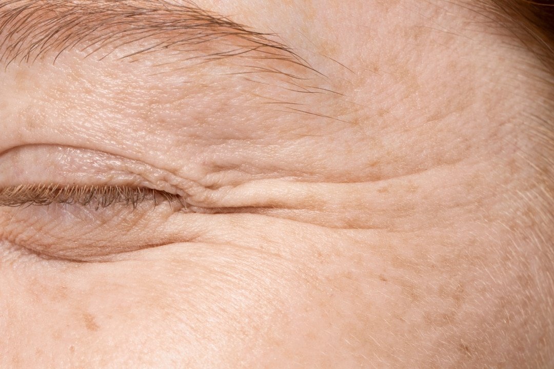 Tratamento de Linhas Finas com Botox Como Rejuvenescer Mantendo a Naturalidade Tratamento de Linhas Finas com Botox: Como Rejuvenescer Mantendo a Naturalidade