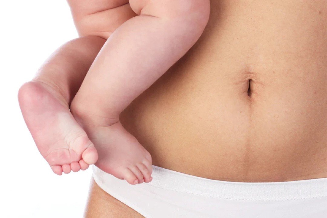 Flacidez Abdominal Pós-Gestação Flacidez-Abdominal-Pós-Gestação