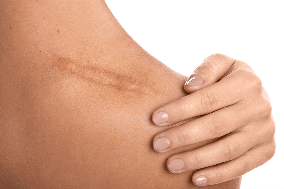 Camuflagem de Cicatriz com Micropigmentação autoestima, naturalidade e resultado real Camuflagem de Cicatriz com Micropigmentação: autoestima, naturalidade e resultado real