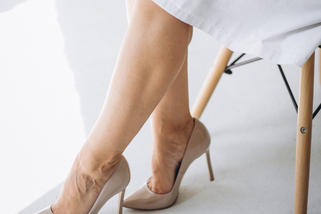 Tratamento de Varizes e Vasos com Laser Fotona e Escleroterapia Tratamento de Varizes e Vasos com Laser Fotona e Escleroterapia