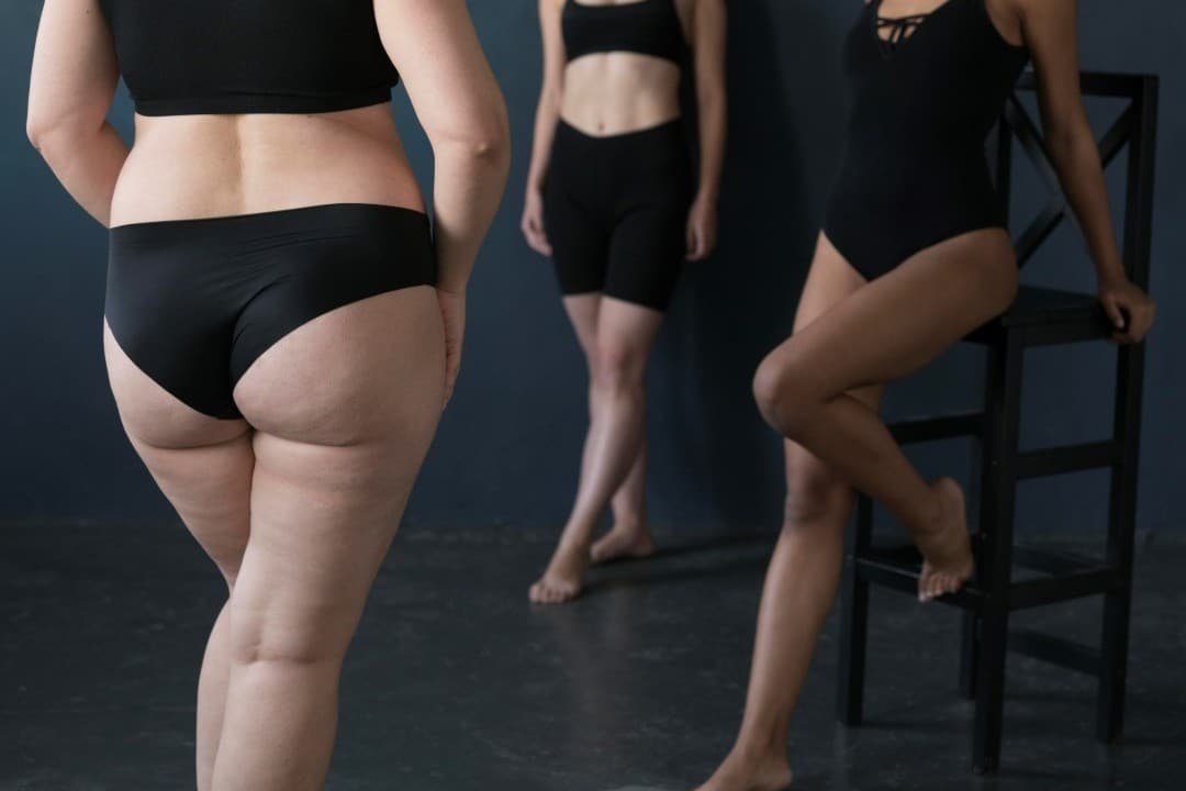 Lipedema o que é e como tratamos na Clínica Dra. Andréa Severa Lipedema: o que é e como tratamos na Clínica Dra. Andréa Severa