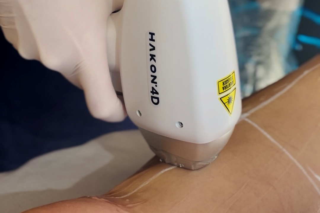 Depilação a Laser em 4D com Hakon Tecnologia, Conforto e Resultados Depilação a Laser em 4D com Hakon: Tecnologia, Conforto e Resultados