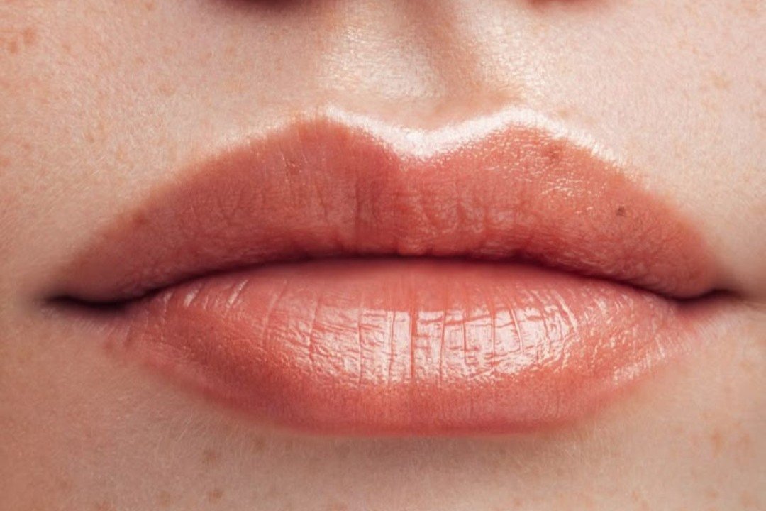 Preenchimento Labial com Ácido Hialurônico Realce Natural da Sua Beleza Preenchimento Labial com Ácido Hialurônico: Realce Natural da Sua Beleza